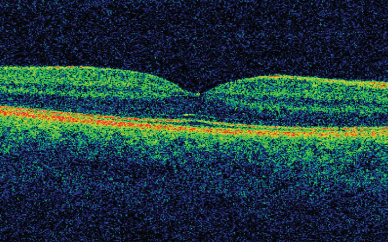 AI on the NHS: how machine intelligence could save the eyesight of thousands