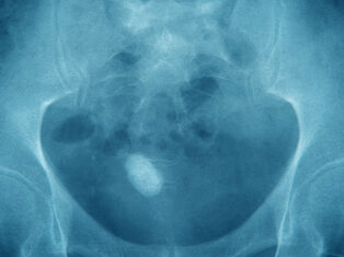 My kidney stone was the least painful part of the new year