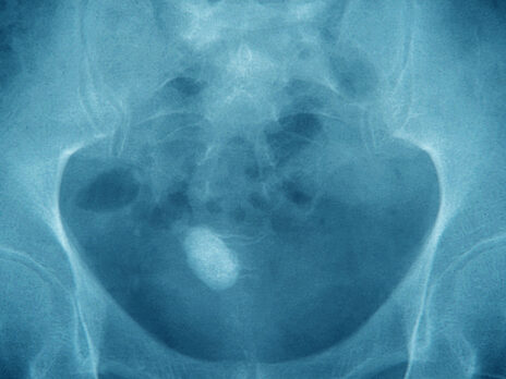 My kidney stone was the least painful part of the new year